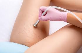 laser stretch mark removal types cost