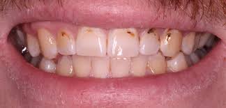 It's called bonding because the material bonds to the tooth. Dental Composite Bonding Cosmetic Bupa Dental Care Uk