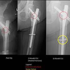 ao ota 31 a1 fracture