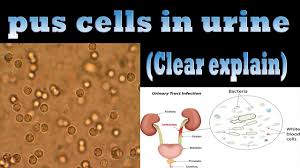 Pus Cells Rbc Bacteria In Urine Uti Patient By Microhub Plus