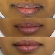 all about laser lip lightening effects