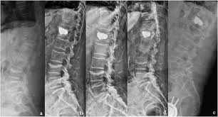 Burst fracture l1 with complete neurological deficit. Efficacy Analysis Of Percutaneous Pedicle Screw Fixation Combined With Percutaneous Vertebroplasty In The Treatment Of Osteoporotic Vertebral Compression Fractures With Kyphosis Journal Of Orthopaedic Surgery And Research Full Text