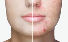 acne large pores oily skin treatment
