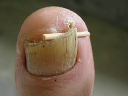 what you should know about toenail fungus