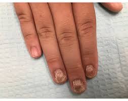 nail psoriasis dr dana stern