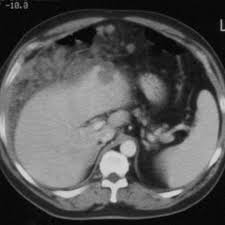 Maybe you would like to learn more about one of these? Malignant Peritoneal Mesothelioma Eurorad