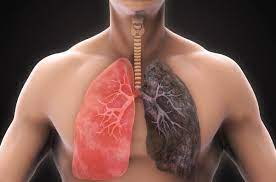 Cancer du poumon : les progrès du traitement sont constants - Pourquoi  Docteur
