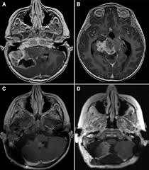 anaplastic ependymoma and posterior
