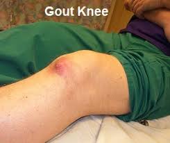 burning knee pain causes symptoms