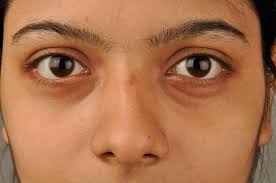 puffy eyes meaning symptoms causes