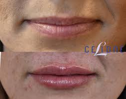 juvederm injections cost