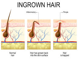 how to stop ingrown hairs anil shah