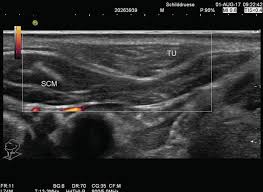 sonography of other neck mes