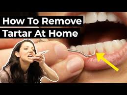 is it possible to remove tartar at home