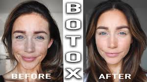 botox treatment before after you