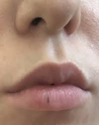 brown line on my bottom lip photo