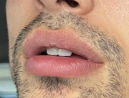 upper lip vermillion border
