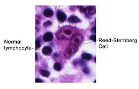 Reed Sternberg Cell Wikipedia