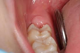 pericoronitis wisdom tooth pain