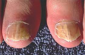 does bleach pen cure toenail fungus