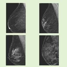 Q A What Does Breast Density Mean Ascension Via Christi