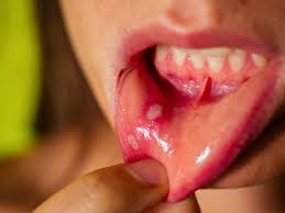 what causes mouth ulcers and how can i