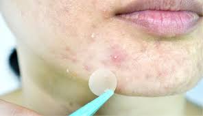 types of acne pictures and treatment