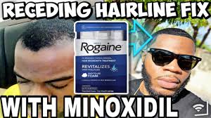 receding thinning hairline