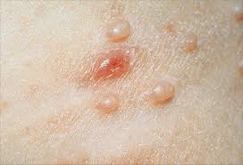 Yeast infection bumps are your skin bumps caused by yeast infection. Pictures Of Viral Skin Diseases And Problems Herpes Zoster