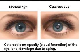 cataract surgery do you have cataract
