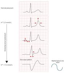 cardiac arrest due to electrolyte