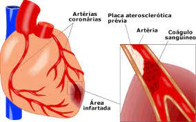 Um enfarte agudo do miocárdio (português europeu) ou infarto agudo do miocárdio (português brasileiro), vulgarmente denominado ataque cardíaco, ocorre quando a circulação de sangue para uma parte do coração é interrompida, causando lesões no músculo cardíaco. Hci Hemodinamica E Cardiologia Invasiva Ver Artigo