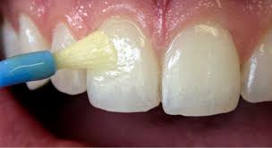 Cavities, also called tooth decay or caries, are caused by a combination of factors, including bacteria in your mouth, frequent snacking, sipping sugary drinks and not cleaning the tooth decay process: What We Re Painting On Your Child S Teeth Fluoride Varnish Pediatric Dental Blog