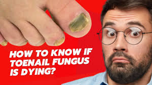 is dying toenail fungus treatment
