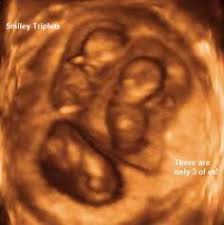 For example, if a woman is seven weeks pregnant and the ultrasound does not reveal a fetal heartbeat, the doctor may order. Pin On First Pregnancy