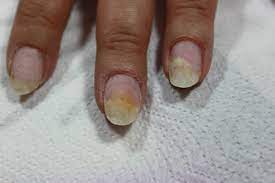 nail spots how ro recognise a mildew