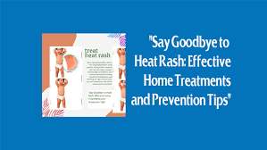 home remes for heat rash