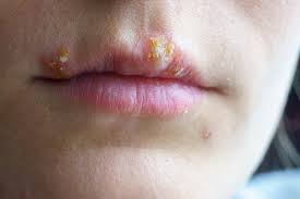 herpes simplex