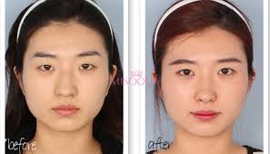 why korean nose augmentation bridge