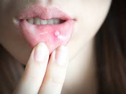 eat to cure mouth ulcers