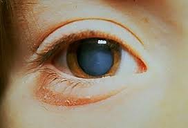 Cataract Surgery Symptoms Treatment Causes