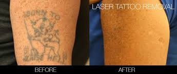 laser tattoo removal toronto see