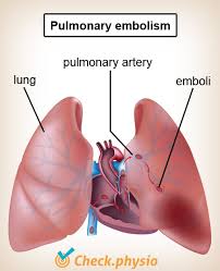Pulmonary embolism (pe) is a medical emergency. Pulmonary Embolism Physio Check