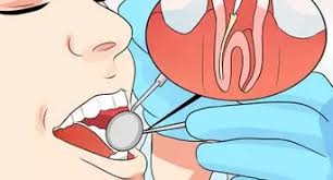 In most cases, going to the dentist will provide you with the best relief. 3 Ways To Stop Wisdom Tooth Pain Wikihow