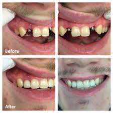 single tooth dental implant ottawa