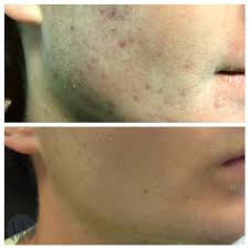 acne scar treatment chevy chase md