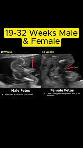  How To Determine Boy Or Girl Using Ultrasound Shorts Youtube gambar png