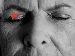 eyelid dermais symptoms treatments