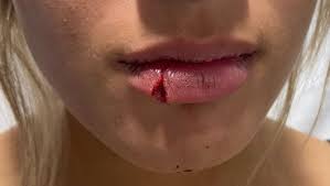 lower lip laceration across the