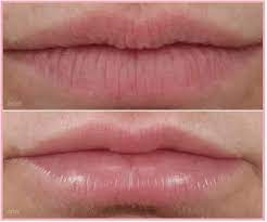 vertical lip lines botox or filler or